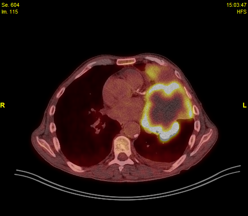 Ενδιαφέρον περιστατικό μεγάλης μάζας καρκίνου του πνεύμονα, στο κεντρικό site της Bristol Myers Squibb (BMS) με πλήρη μεταβολική ανταπόκριση χωρίς τη διενέργεια χειρουργείου με τη χρήση νεότερης γενιάς συνδυασμού ανοσοθεραπείας